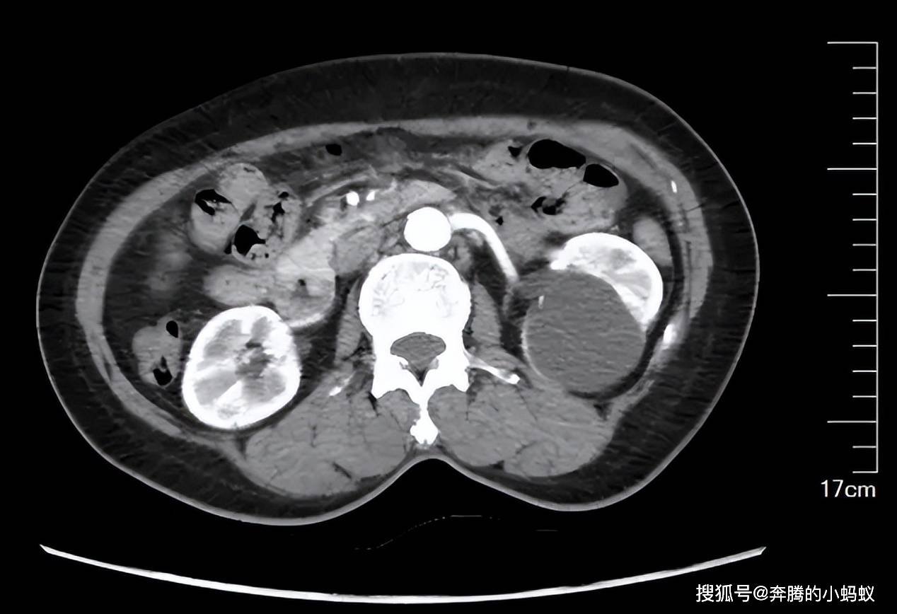 肾囊肿分单纯性和获得性