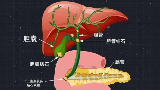 突發節後腹痛膽結石患者需要時刻注意飲食