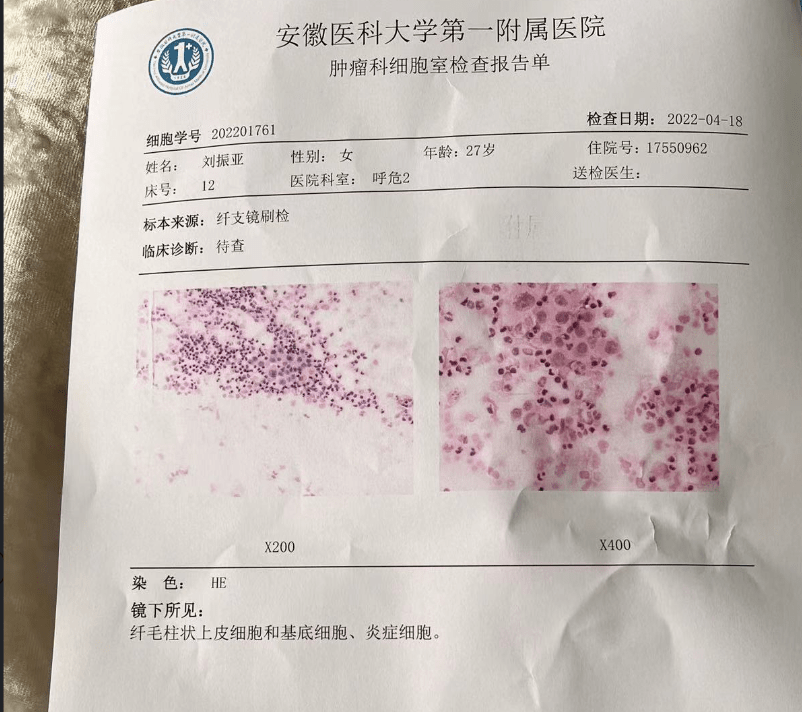 之后,刘振亚住院,做支气管镜的检查,确诊支原体感染.