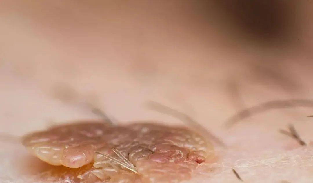 尖锐湿疣的发生机制为hpv首先进入人体黏膜皮肤后,潜伏在基底角朊细胞