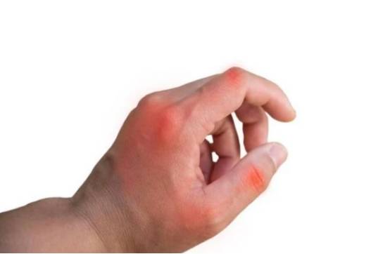 尿酸高的人手上若出现这3个异常或是肾衰竭已靠近我们