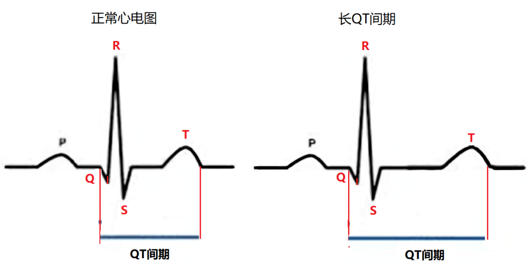 坏死性q波是什么图片