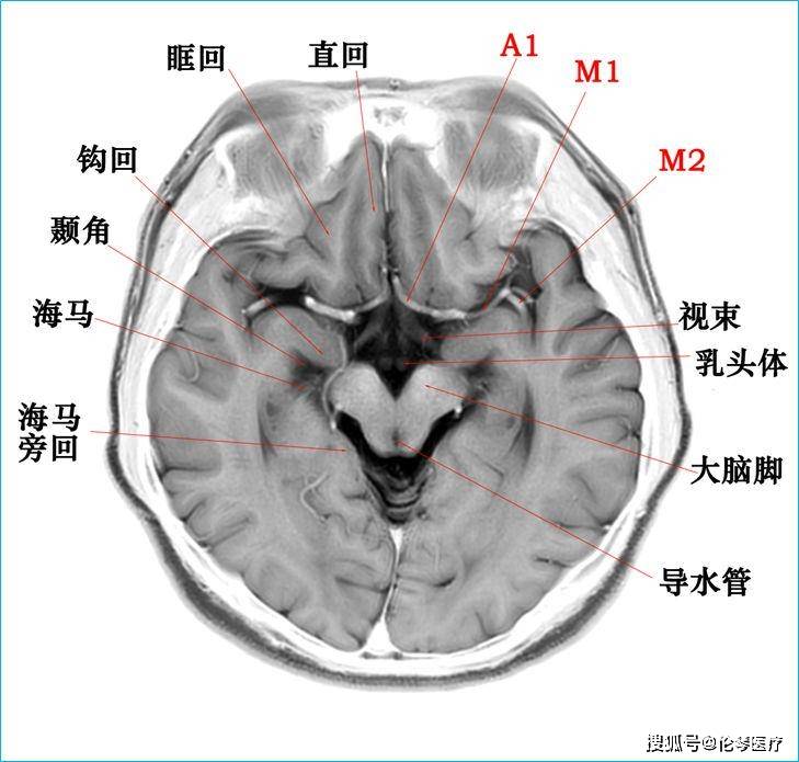 颞叶横断面图片