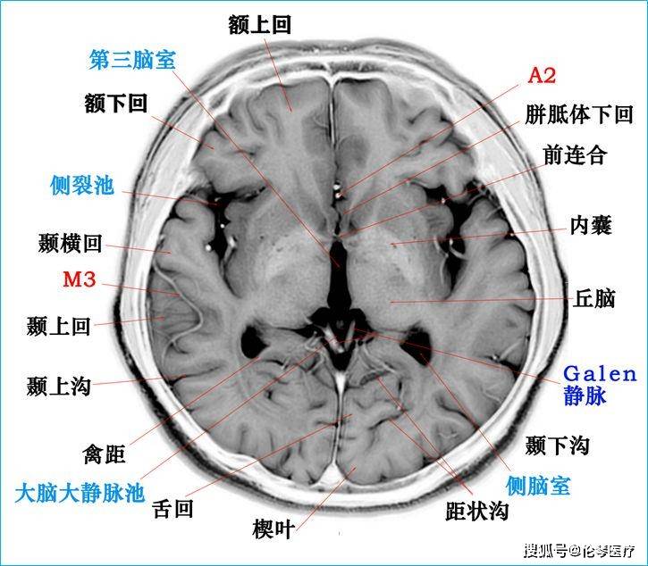 超赞高清颅脑断层解剖图谱磁共振大体标本