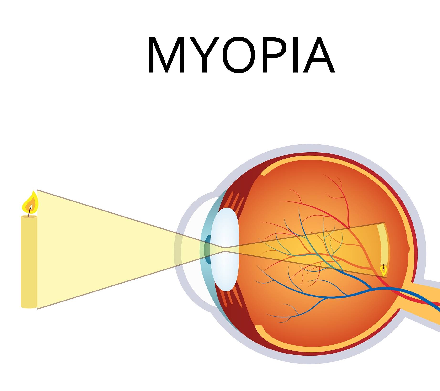 眼睛就像一个光学系统,近视眼就是这个光学系统出了问题,即眼轴拉长.