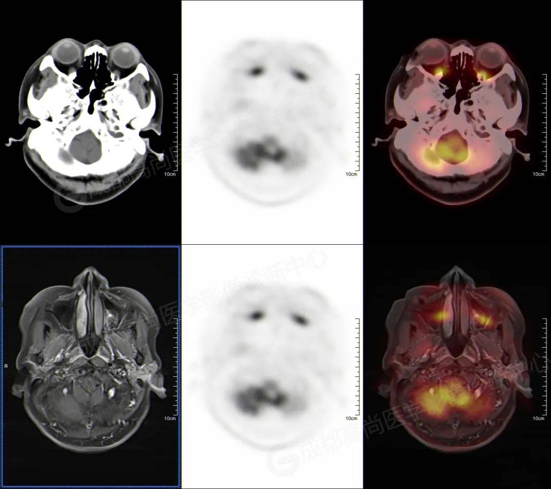 【高尚病例】pet-ct/mri多模态检查实现"一站式"诊断_病变_融合_临床