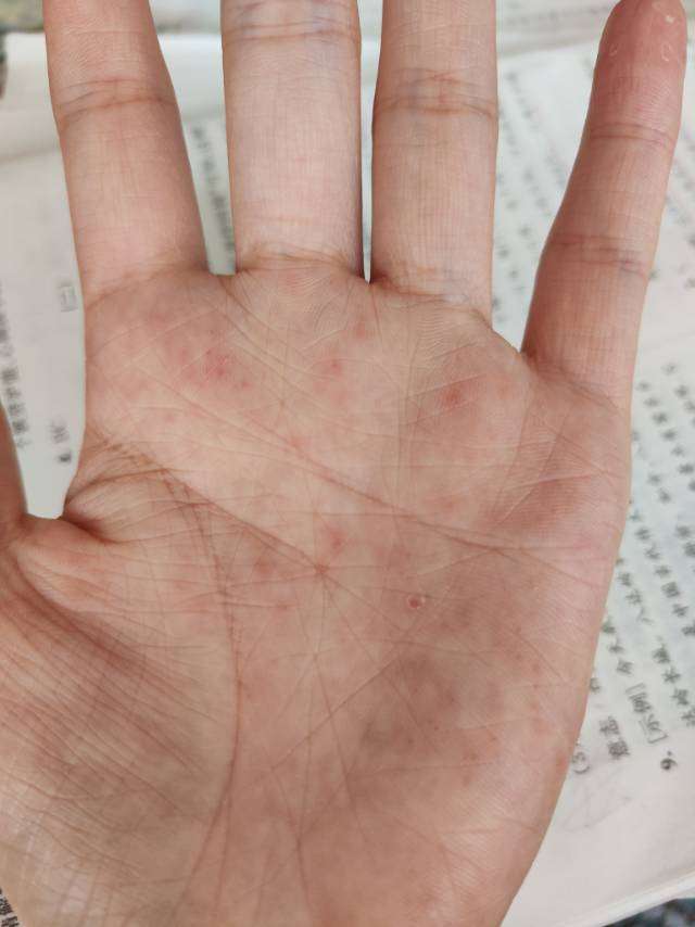 手上起透明小水泡很痒怎么回事有脱皮