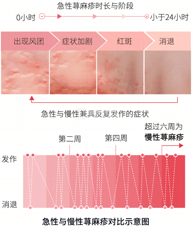 徐州中医名松堂秋冬发痒起风团荨麻疹该怎么办