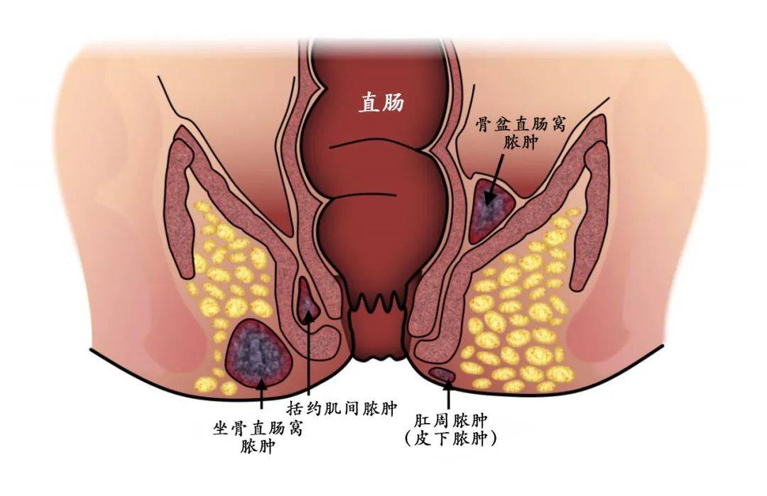 肛周脓肿是怎么变成肛瘘的