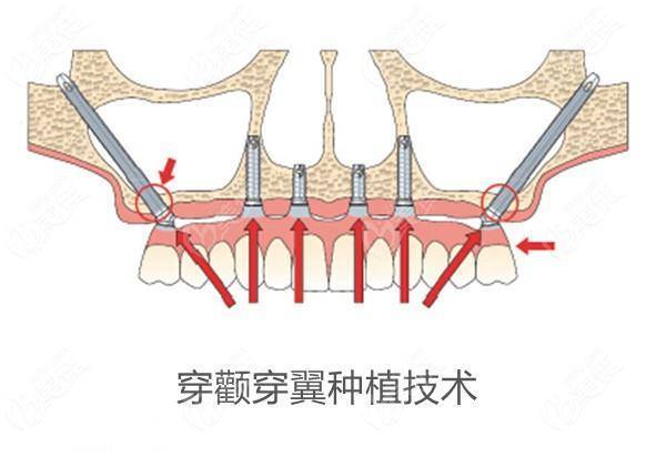 穿颧骨种植牙示意图图片