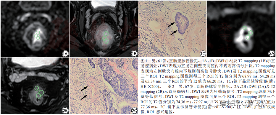 t2 mapping预测直肠癌脉管侵犯的初步研究