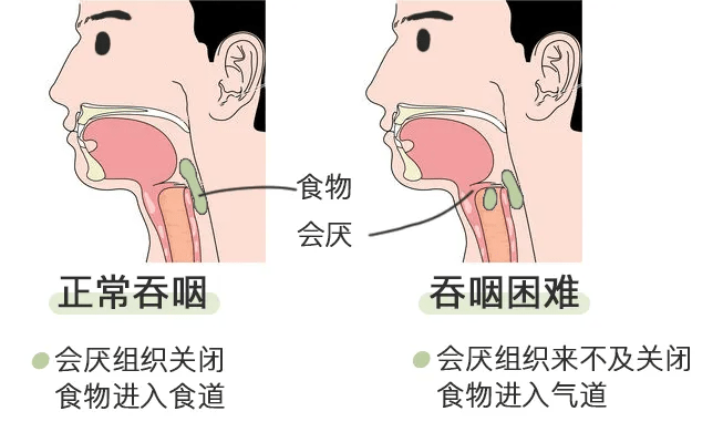 吞咽时有梗阻感