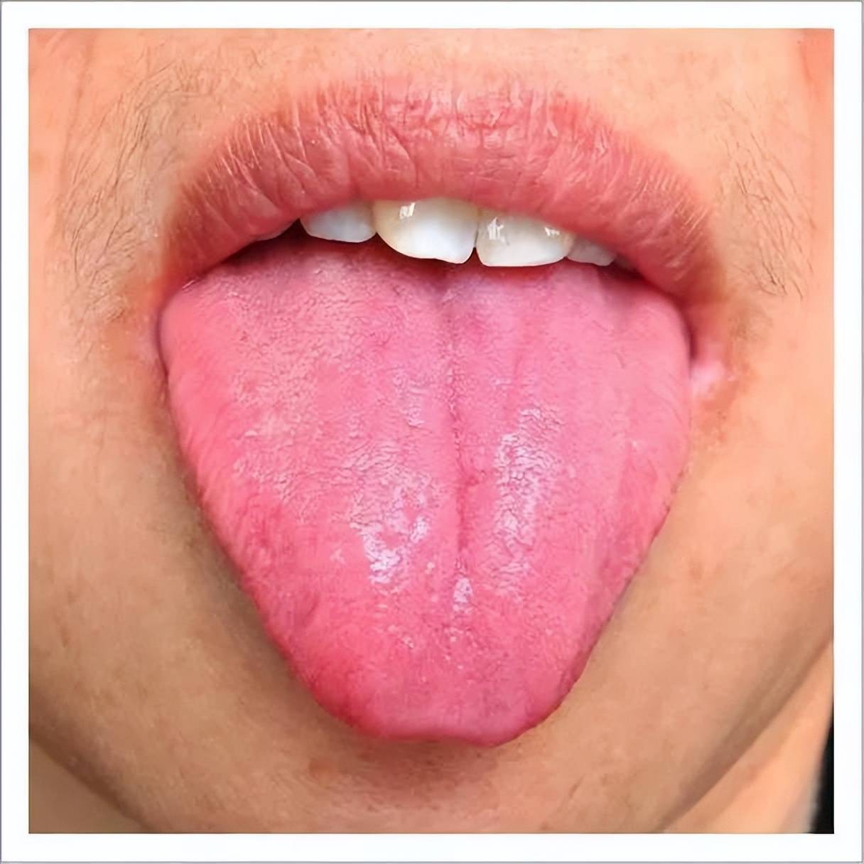 舌头上白白的到底是什么？_凤凰网视频_凤凰网