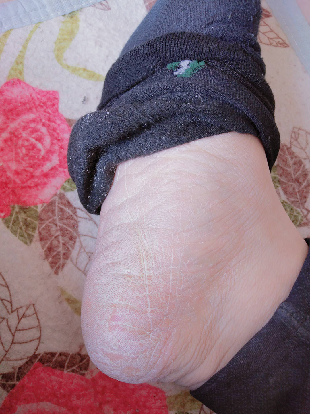 原创脚后跟干裂起硬皮裂口子怎么办你以为是老了