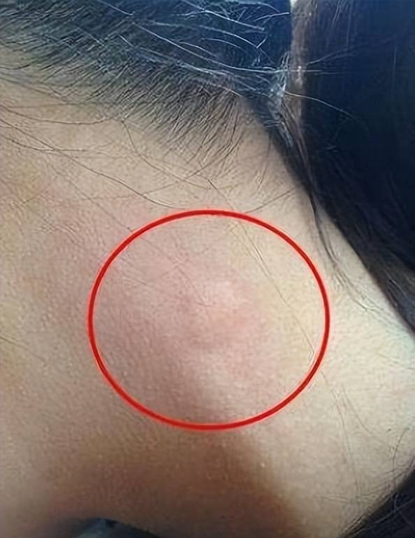 我看到她脖子淋巴结已经肿大,且脖子上的纹身也引起了我的注意,那是三