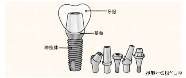 种植牙的材质通常用于种植钉和基台部分,纯钛材质是目前来说较优的