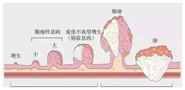 青岛京北胃肠医院:发现肠息肉一定要切除吗?_病理_癌变_内镜