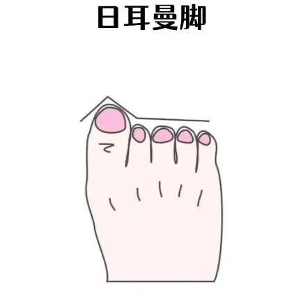 日耳曼脚很少见,拥有这种脚型的人通常是为芭蕾舞而生的.