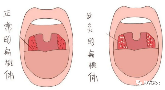 臨床表現為起病急,惡寒發熱(體溫達38~40℃,小兒可引起驚厥),頭痛