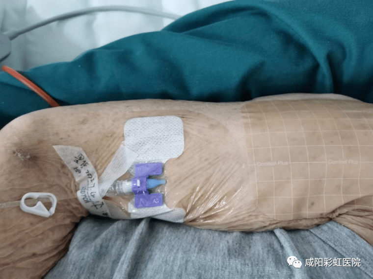 咸阳彩虹医院成人病区迷你中线导管置入术