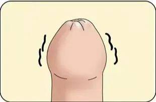 7415 包皮嵌顿包皮嵌顿多见于包茎,在包皮被强行翻开后,包皮口