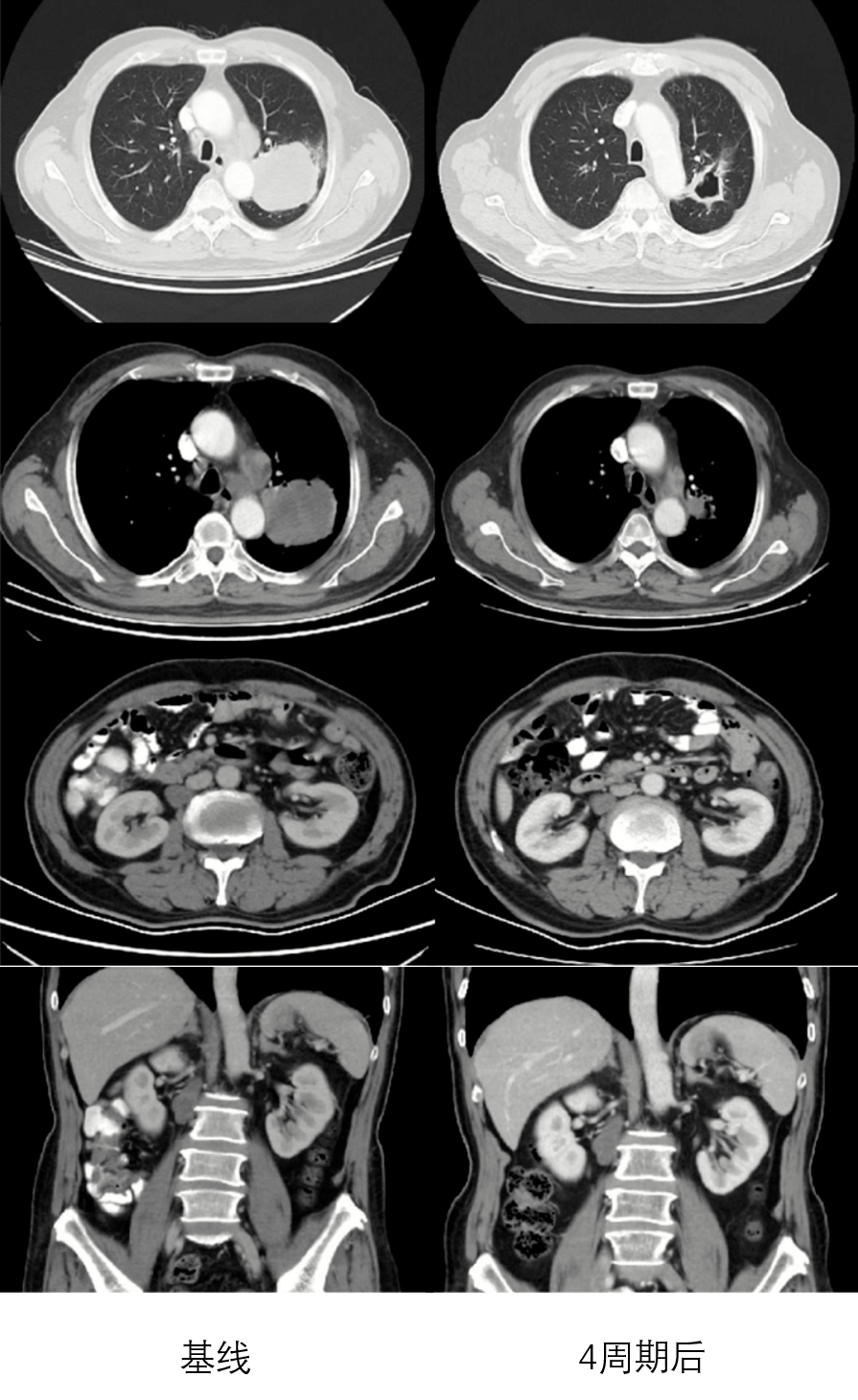 iva期(纵隔,左肺门淋巴结转移 腹膜后淋巴结转移),egfr,alk野生型