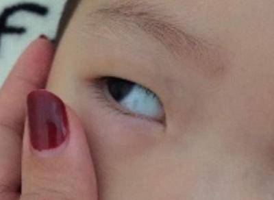 原创孩子眼珠白部有黑点大多因为3点早知道早预防