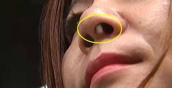 假体外露,女子怒找媒体曝光,商家:6年前做的,我也想知道原因_陈女士