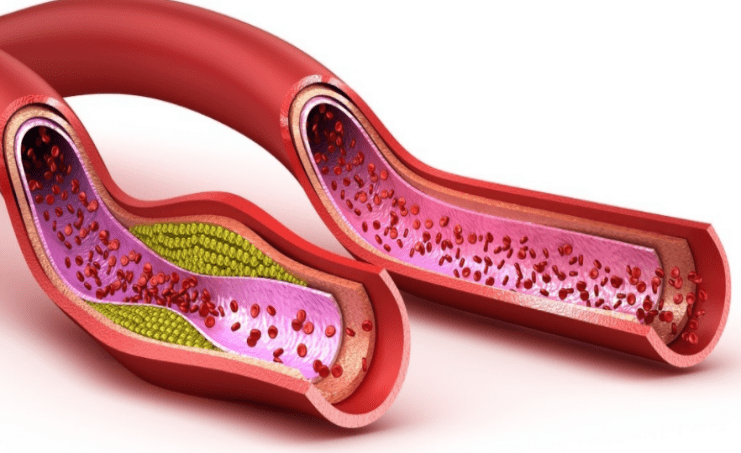 寿命长短取决于血管健康程度