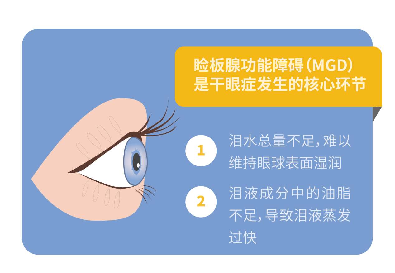 為什麼乾眼患者,問題都出在瞼板腺上?_淚液_油脂_眼睛