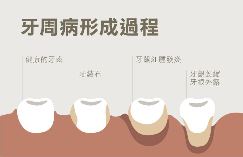 牙周炎除了会有上述的症状外,进而侵犯牙龈下方的齿槽骨和牙周韧带.