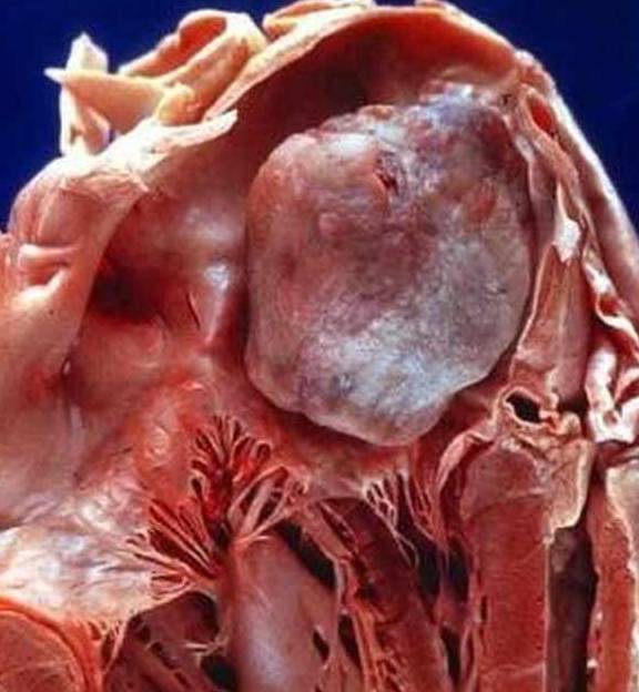 再请大家看一张非常典型的左心房粘液瘤病理标本图片.