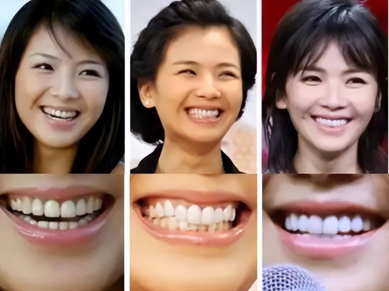 刘涛牙齿脱落,吴宣仪嘴巴合不上,明星们的大白牙真的好看吗?