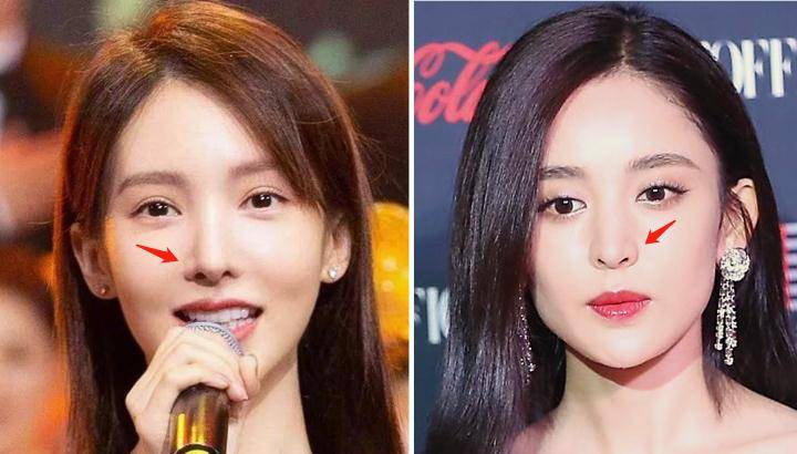 鼻翼_鼻头_软骨