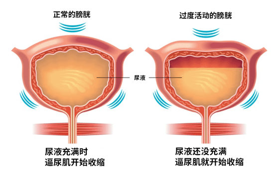 膀胱过度活动症(oab)指排尿时,由于膀胱逼尿肌(do)不自主收缩所造成的