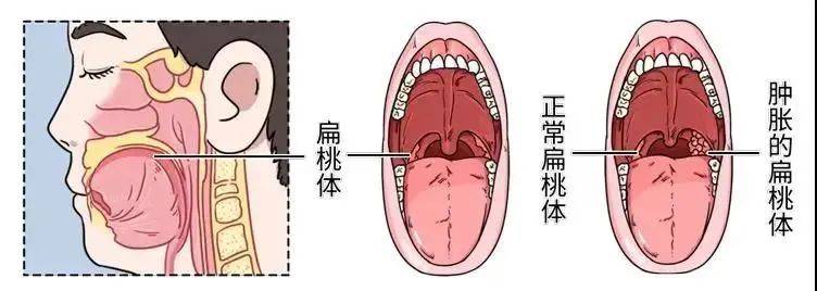 成都民生耳鼻喉醫院:腺樣體肥大的必須做手術嗎 腺樣體怎麼治療