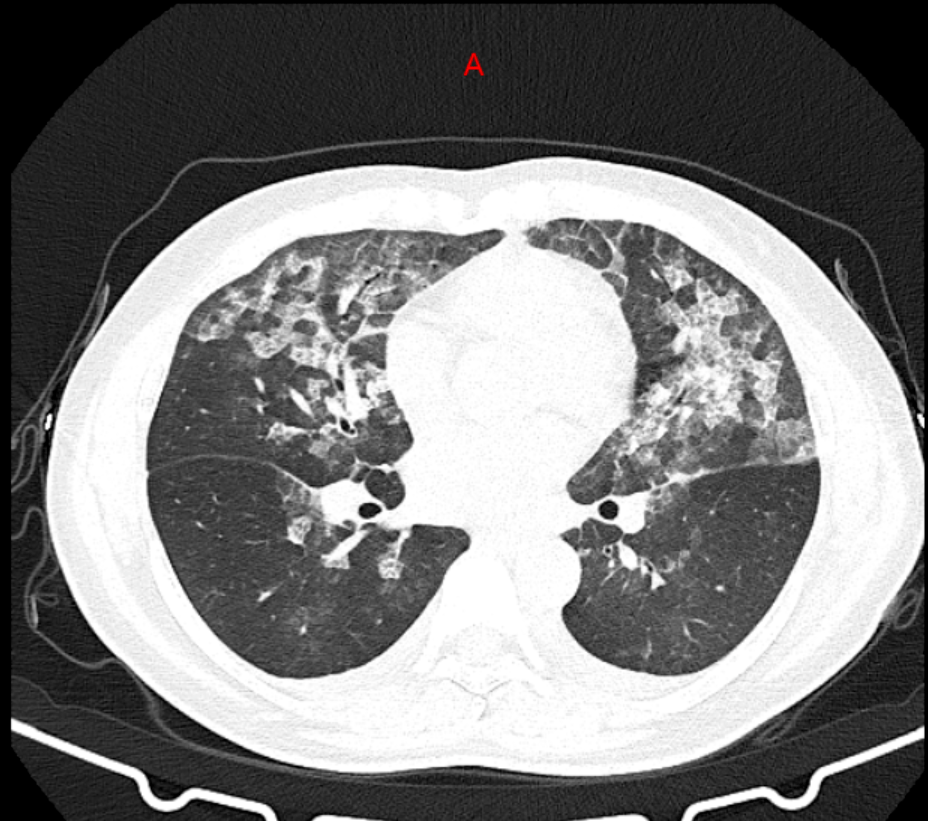 肺部ct报告单图片图片