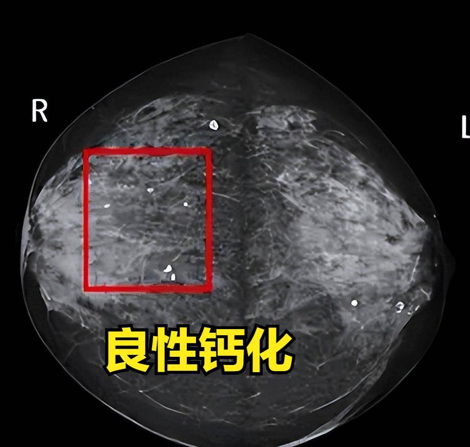 乳腺癌钼靶报告单该怎么看?教你读懂乳腺钼靶报告_钙化_检查_形态