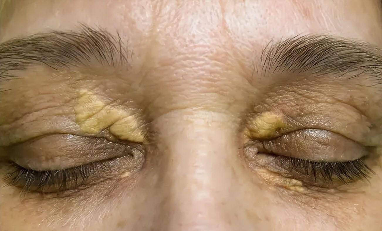 血脂高的人,若头部有4个现象,血液已"粘稠如粥",小心脑梗_血管_代谢