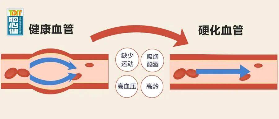 人与动脉同寿,血管硬化会对身体造成不利影响_康复_疾病_治疗