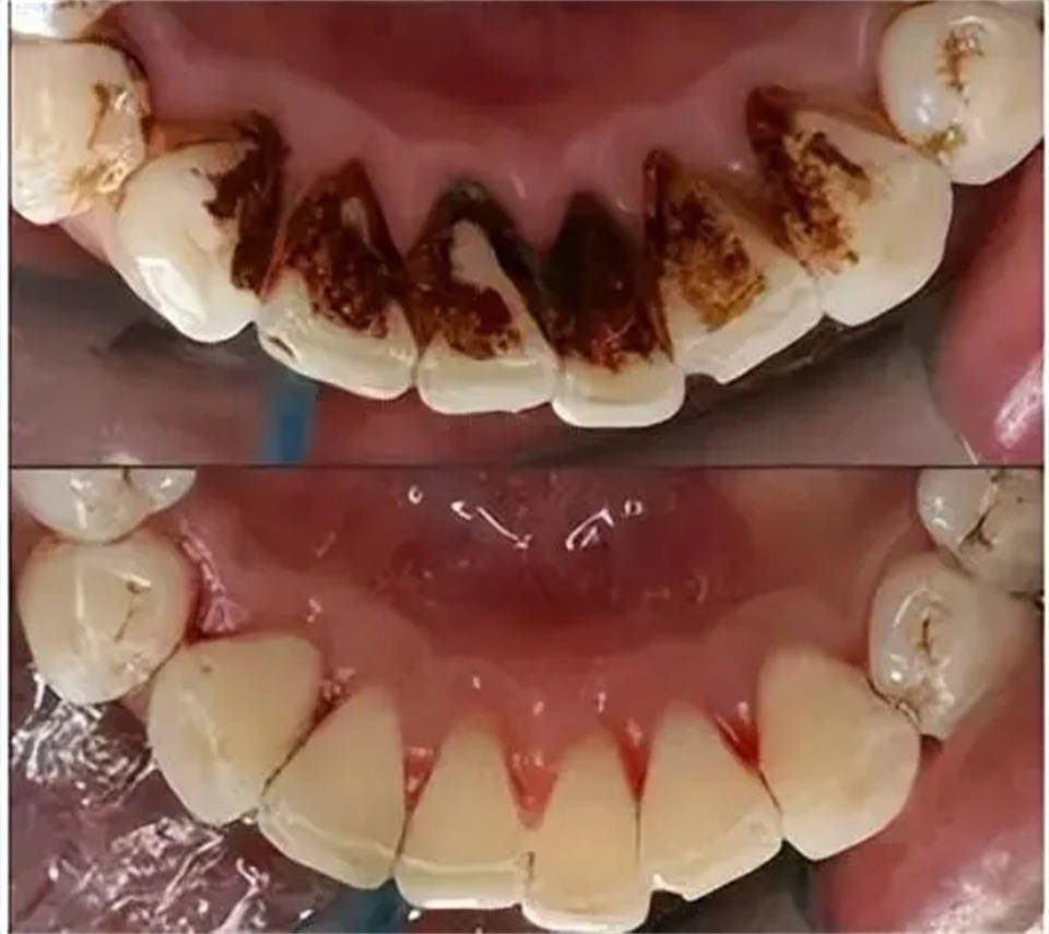 每天只要几毛钱就能清除亮白除渍!_效果_牙齿_牙膏