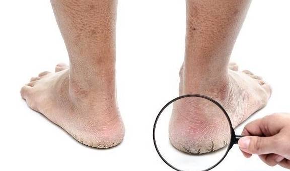 为啥有人脚后跟容易"干裂"?