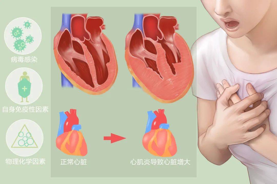 病毒性心肌炎是指病毒感染引起的心肌局限性或弥漫性的急性或慢性炎症