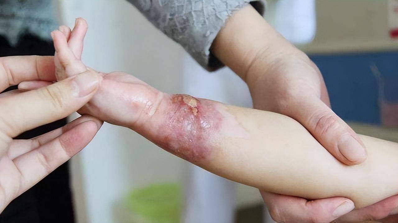 弟弟被开水烫伤,12岁姐姐的处理方式堪称教科书,医生连竖大拇指_孩子