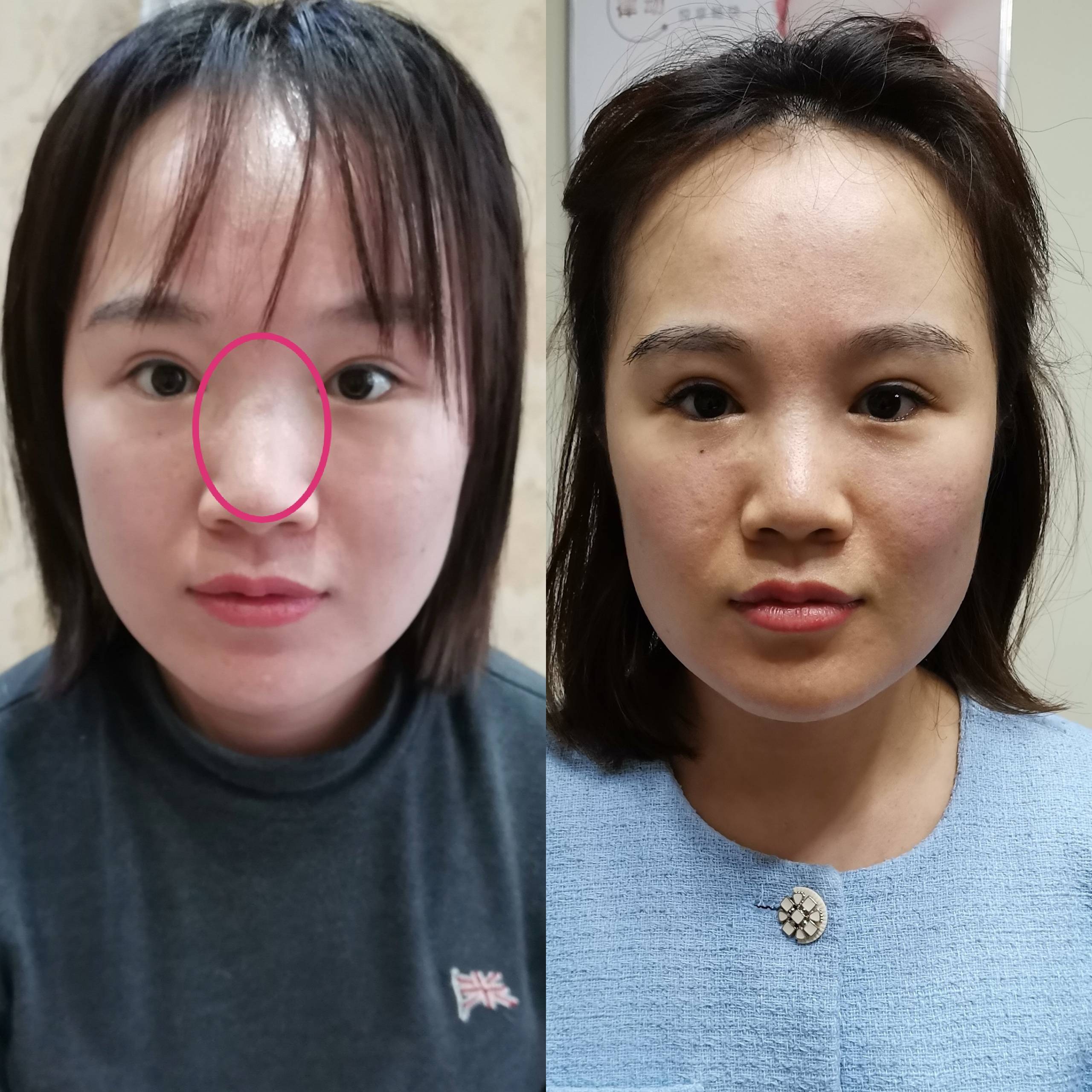 鼻子假体填充微整形有哪几种方法?效果哪家专业?排名 怎么收费?