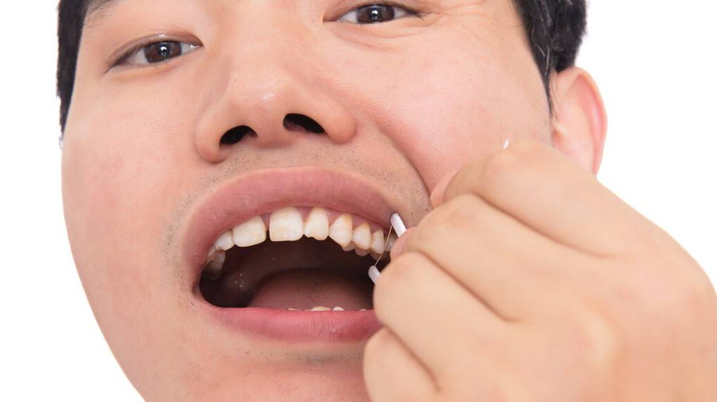 牙宣怎么治疗图片