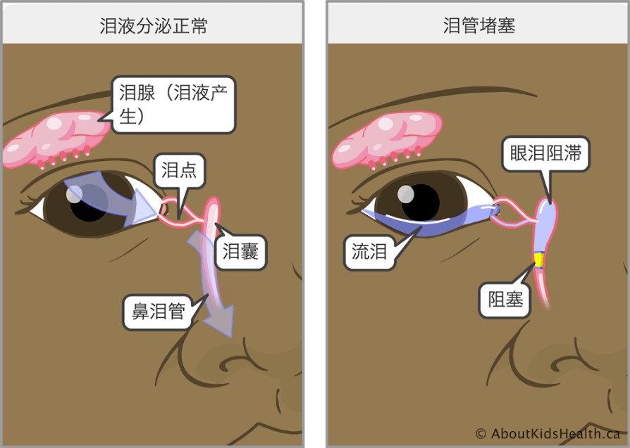 这种疾病会导致结膜炎,还会引起面部畸形,超过1岁的宝宝要注意