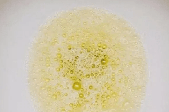 如果肾小球,肾盂等地方有大量的尿酸盐结晶沉淀,会对肾脏的过滤功能