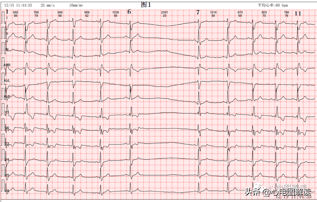 室性停搏心电图图片
