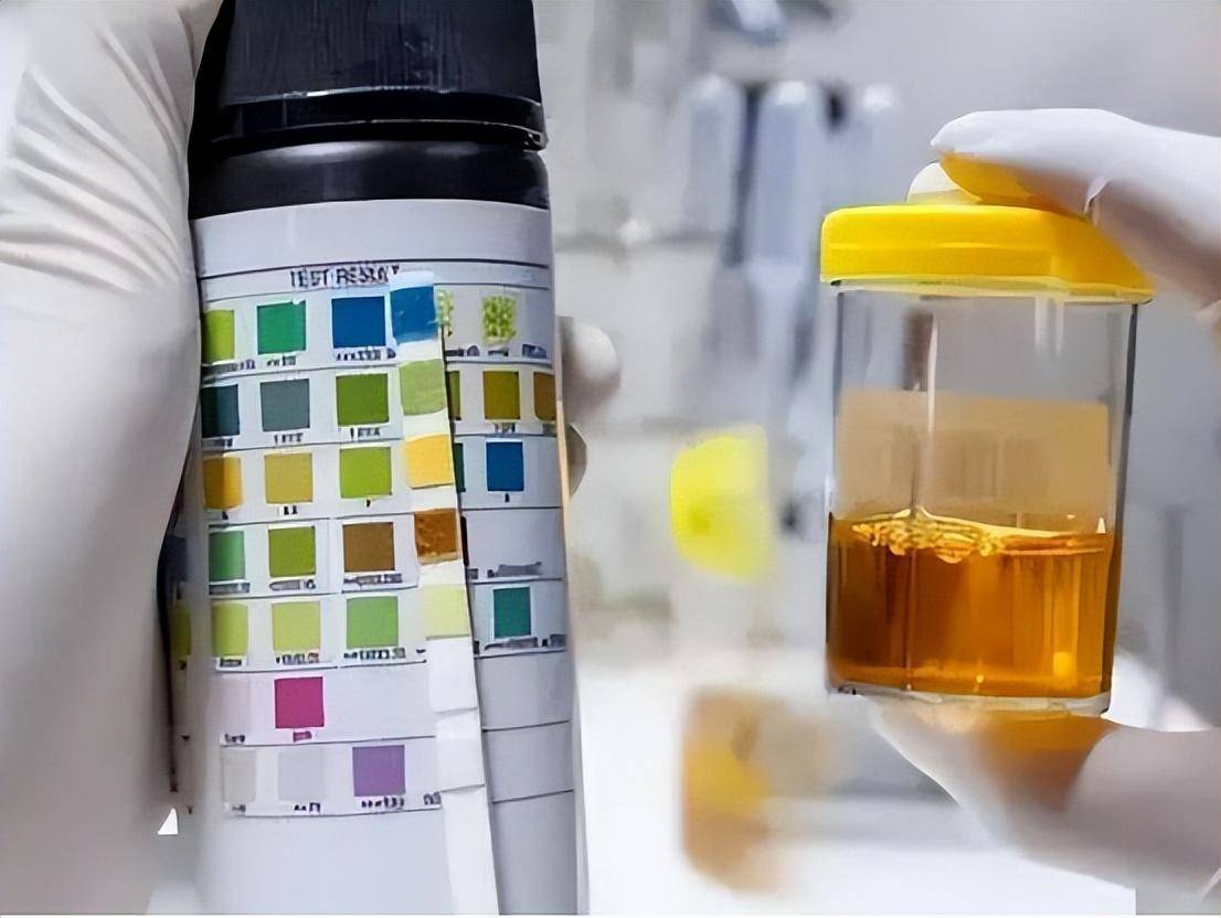 45岁男子每天大便两三次,确诊胰腺癌!